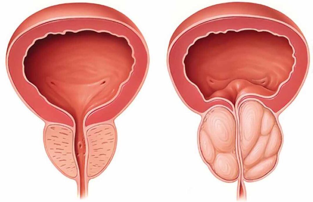 Prostatako normala eta prostatako guruinaren hantura (prostatitis kronikoa)
