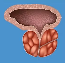 Prostatitisaren seinale ezaugarriak