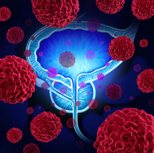 Mikroorganismo patogenoen jarduera prostatitisaren garapenaren kausa da