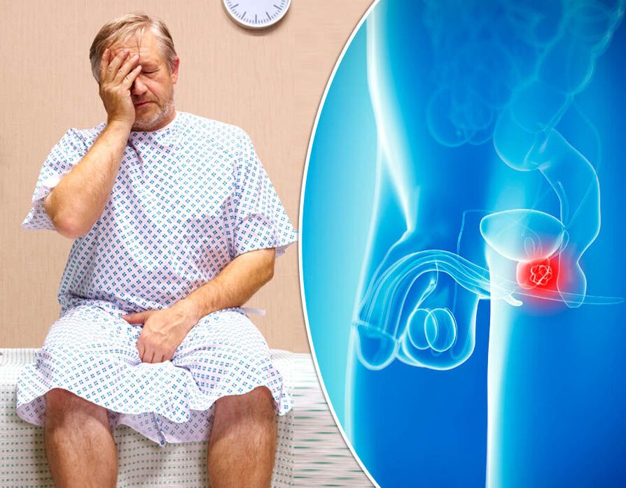 Prostatitisa duen gizon batek gaixotasunaren diagnostikoa egiten du