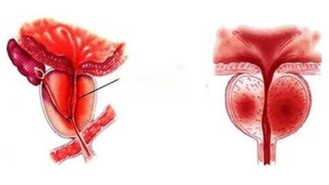 Zer itxura du prostatitis kronikoa